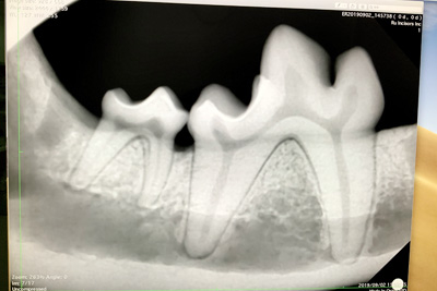 歯科用レントゲン