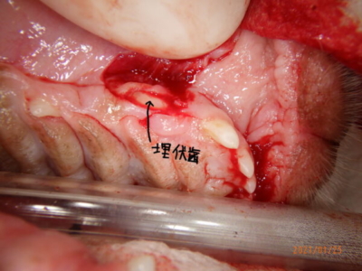 埋もれていた犬歯を露出
