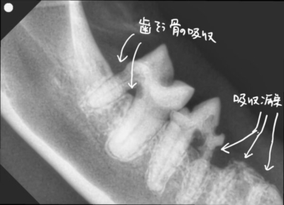歯周病による歯槽骨の吸収と、歯の根本の吸収病巣