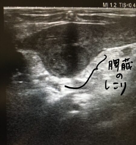 猫の脾臓の腫瘍、形質細胞腫(骨髄腫関連疾患 FMRD) - 症例集 - 練馬で